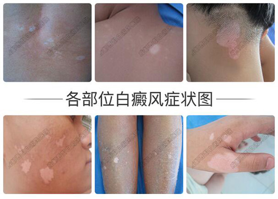 一:局部皮肤出现白色斑
