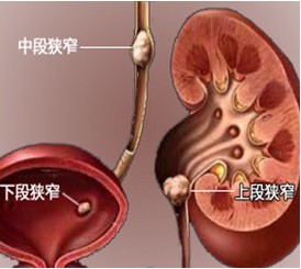 尿道結石是怎麼引起的